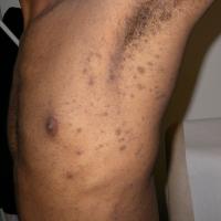 
	Lichen planus pigmentosus

	This had never been…