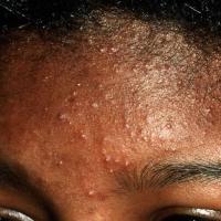 
	Pomade acne