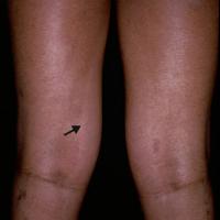 
	Pigmentary demarcation lines