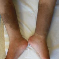 
	Atopic eczema and post-inflammatory…