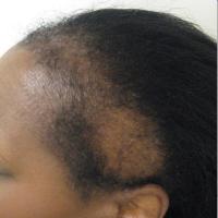 
	Traction alopecia