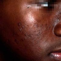 
	Acne

	Active lesions and post-inflammatory…