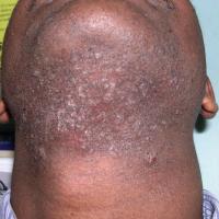 
	Pseudofolliculitis barbae