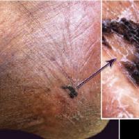 
	Acral lentiginous melanoma

	In some cases the…