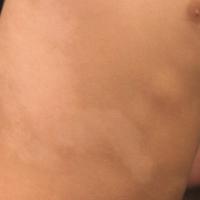 
	Naevus depigmentosus