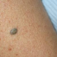 
	Blue naevus on the forearm