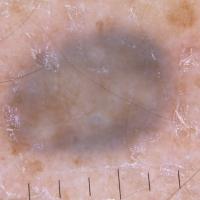 Dermoscopic appearance of previous figure&nbsp;
