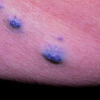 
	Blue Rubber Bleb Naevus syndrome