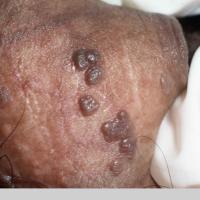 
	Bowenoid papulosis&nbsp;