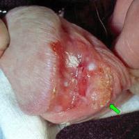 
	Squamous cell carcinoma&nbsp;

	Ulcer with…