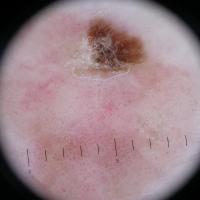 Dermoscopic appearance of previous…