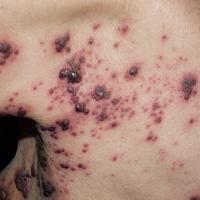 
	Herpes zoster

	The bullae can become necrotic