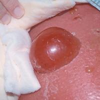 
	Bullae&nbsp;due to leg oedema and secondary…