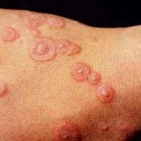 
	Erythema multiforme

	&nbsp;