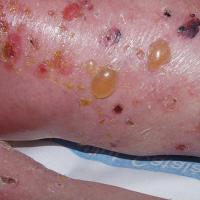 
	Bullous pemphigoid
Copied with kind…