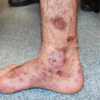 
	Erythema multiforme