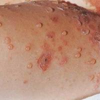 
	Bullous impetigo