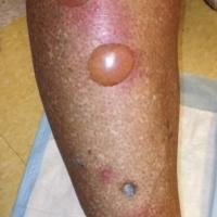 
	Bullous diabetoricum 