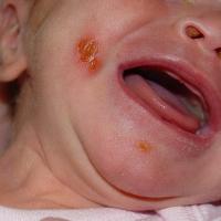 
	Bullous impetigo