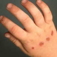 
	Child abuse - cigarette burns 