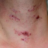 
	Dermatitis herpetiformis
