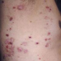 
	Epidermolysis bullosa acquisita - generalised…