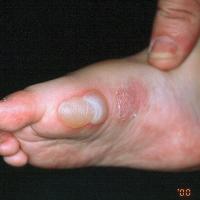 
	Localised epidermolysis bullosa…