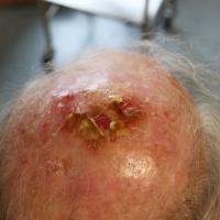 
	Erosive pustular dermatosis