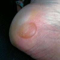 
	Friction blisters - secondary to hiking 