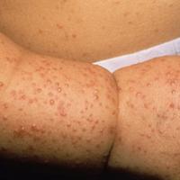 
	Gianotti-Crosti syndrome