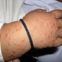 
	Gianotti-Crosti syndrome