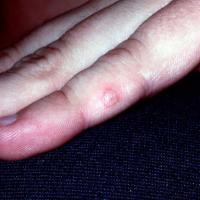 
	Hand, foot and mouth disease