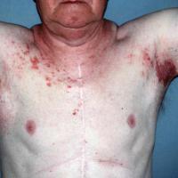 
	Hailey-Hailey disease