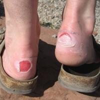 
	Friction blisters - secondary to hiking
