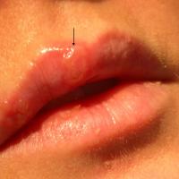 
	Herpes simplex