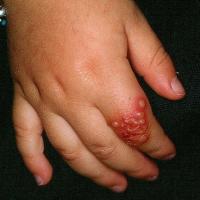 
	Herpes simplex

	Copied with kind permission…