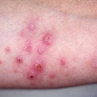 
	Lymphomatoid papulosis