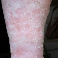 
	Bullae secondary to leg oedema