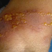 
	Linear IgA disease&nbsp;
