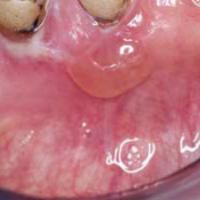 
	Mucous membrane pemphigoid