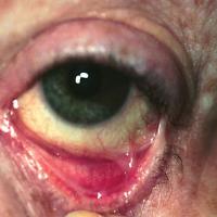 
	Mucous membrane pemphigoid