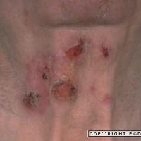 
	Mucous membrane pemphigoid