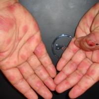 
	Orf and erythema multiforme

	Erythema…