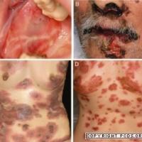 
	Paraneoplastic pemphigus