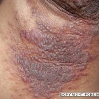 
	Pemphigus vegetans
Copied with kind…