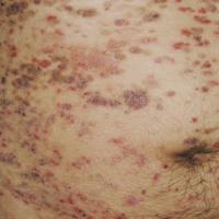 
	Pemphigus foliaceous

	Copied with kind…