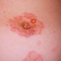 
	Pemphigoid gestationis

	Copied with kind…