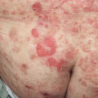 
	Pemphigus vulgaris&nbsp;