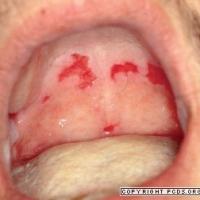 
	Pemphigus vulgaris