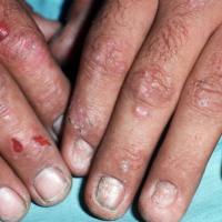 
	Porphyria cutanea tarda

	Bullae, skin…
